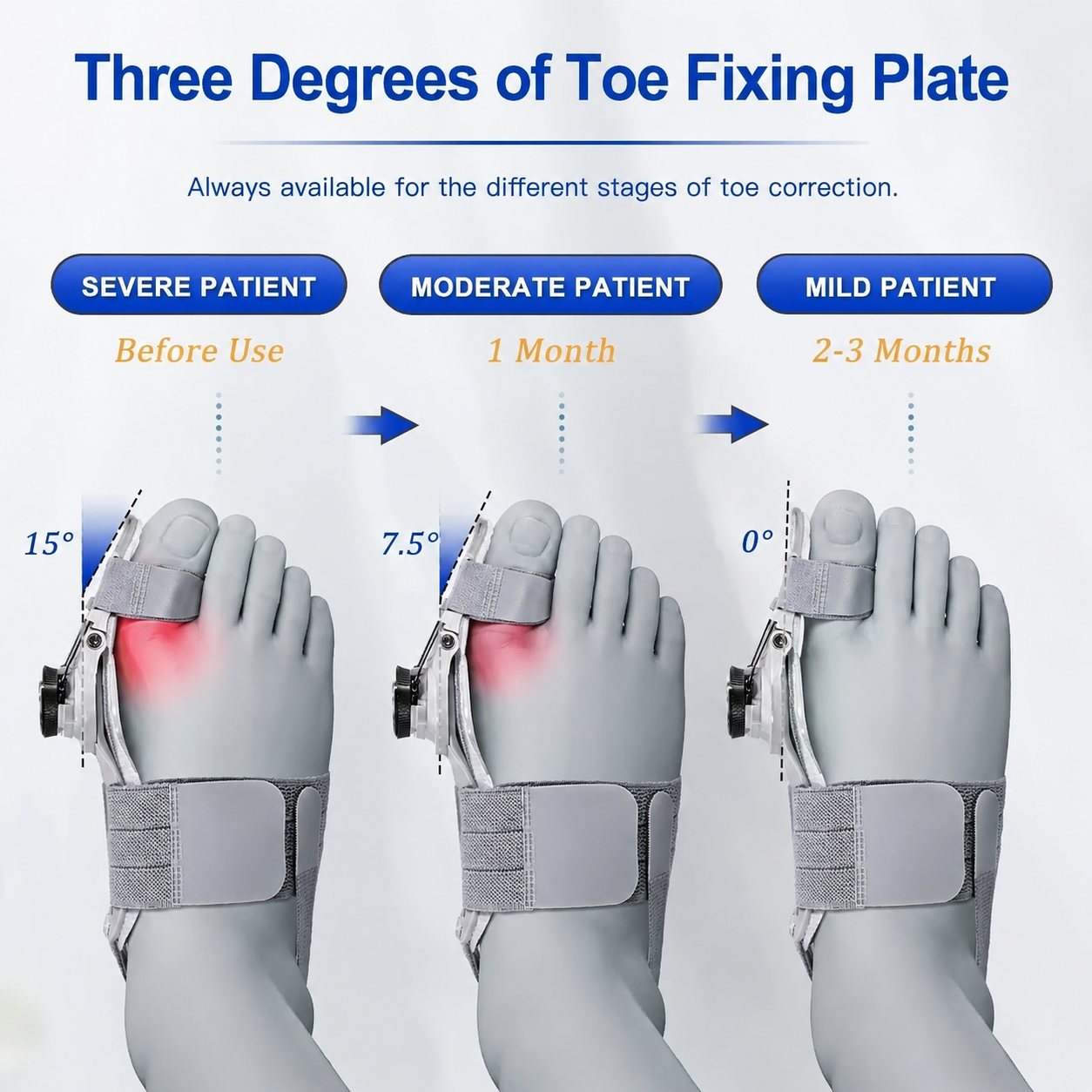 Adjustable Bunion Corrector for Pain Relief